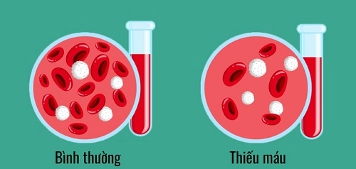 Bệnh thiếu máu thiếu sắt: Nguyên nhân, triệu chứng và điều trị